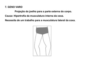 7. GENO VARO
        Projeção do joelho para a parte externa do corpo.
Causa: Hipertrofia da musculatura interna da coxa.
Necessita de um trabalho para a musculatura lateral da coxa.
 