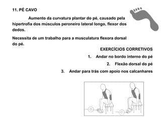 11. PÉ CAVO

         Aumento da curvatura plantar do pé, causado pela
hipertrofia dos músculos peroneiro lateral longo, flexor dos
dedos.

Necessita de um trabalho para a musculatura flexora dorsal
do pé.
                                            EXERCÍCIOS CORRETIVOS
                                       1.   Andar no bordo interno do pé
                                                 2.   Flexão dorsal do pé
                         3.   Andar para trás com apoio nos calcanhares
 