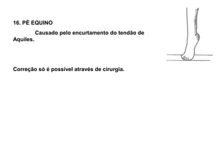 16. PÉ EQUINO
           Causado pelo encurtamento do tendão de
Aquiles.




Correção só é possível através de cirurgia.
 