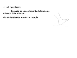17. PÉ CALCÂNEO
       Causado pelo encurtamento do tendão do
músculo tibial anterior.

Correção somente através de cirurgia.
 