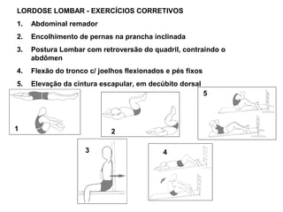 LORDOSE LOMBAR - EXERCÍCIOS CORRETIVOS
1.   Abdominal remador
2.   Encolhimento de pernas na prancha inclinada
3.   Postura Lombar com retroversão do quadril, contraindo o
     abdômen
4.   Flexão do tronco c/ joelhos flexionados e pés fixos
5.   Elevação da cintura escapular, em decúbito dorsal
                                                           5




1                           2

                     3                      4
 