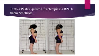 Tanto o Pilates, quanto a fisioterapia e o RPG te
trarão benefícios.
 
