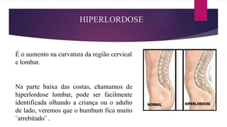 HIPERLORDOSE
É o aumento na curvatura da região cervical
e lombar.
Na parte baixa das costas, chamamos de
hiperlordose lombar, pode ser facilmente
identificada olhando a criança ou o adulto
de lado, veremos que o bumbum fica muito
¨arrebitado¨ .
 