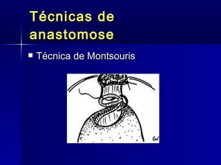 Técnicas de anastomose Técnica de Montsouris 