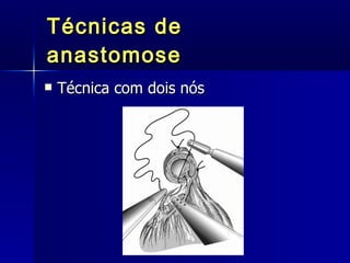 Técnicas de anastomose Técnica com dois nós 