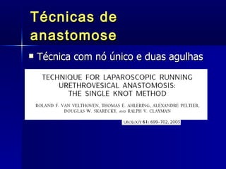 Técnicas de anastomose Técnica com nó único e duas agulhas 