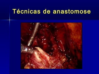 Técnicas de anastomose 