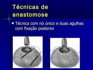 Técnicas de anastomose Técnica com nó único e duas agulhas com fixação posterior 