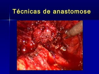 Técnicas de anastomose 