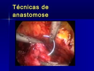 Técnicas de anastomose 