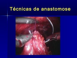 Técnicas de anastomose 