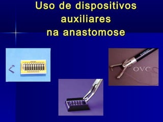 Uso de dispositivos auxiliares na anastomose 