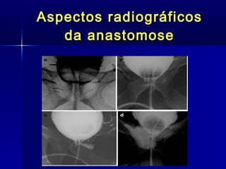 Aspectos radiográficos da anastomose 