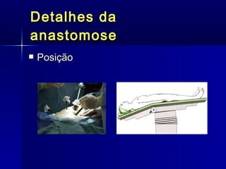 Detalhes da anastomose Posição 