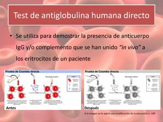Test de antiglobulina humana directo 
• Se utiliza para demostrar la presencia de anticuerpo 
IgG y/o complemento que se han unido “in vivo” a 
los eritrocitos de un paciente 
Antes Después 
A la imagen se le aplicó una modificación de la saturación a -100 
 