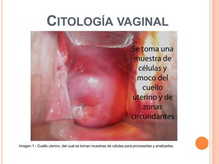CITOLOGÍA VAGINAL 
Imagen 1.- Cuello uterino, del cual se toman muestras de células para procesarlas y analizarlas. 
 