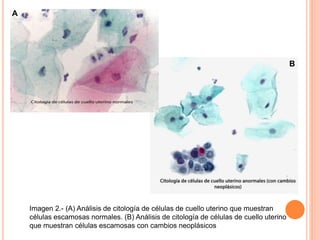 Imagen 2.- (A) Análisis de citología de células de cuello uterino que muestran 
células escamosas normales. (B) Análisis de citología de células de cuello uterino 
que muestran células escamosas con cambios neoplásicos 
A 
B 
 