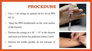 PROCEDURE
1. Use a 1 ml syringe to aspirate out 0.1 ml of PPD
RT 23.
2. Inject the PPD intradermally on the volar surface
of the forearm.
3. Position the syringe at a 10 ° - 15° to the forearm
and insert just below the epidermis (about 2 mm)
4. Remove the needle quickly, do not massage or
use.
 