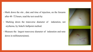 • Mark down the site , date and time of injection, on the forearm
after 48 -72 hours, read the test result by
• Marking down the transverse diameter of induration, not
erythema, by Sokal's ballpoint method.
• Measure the largest transverse diameter of induration and note
down in millimeters(mm).
 