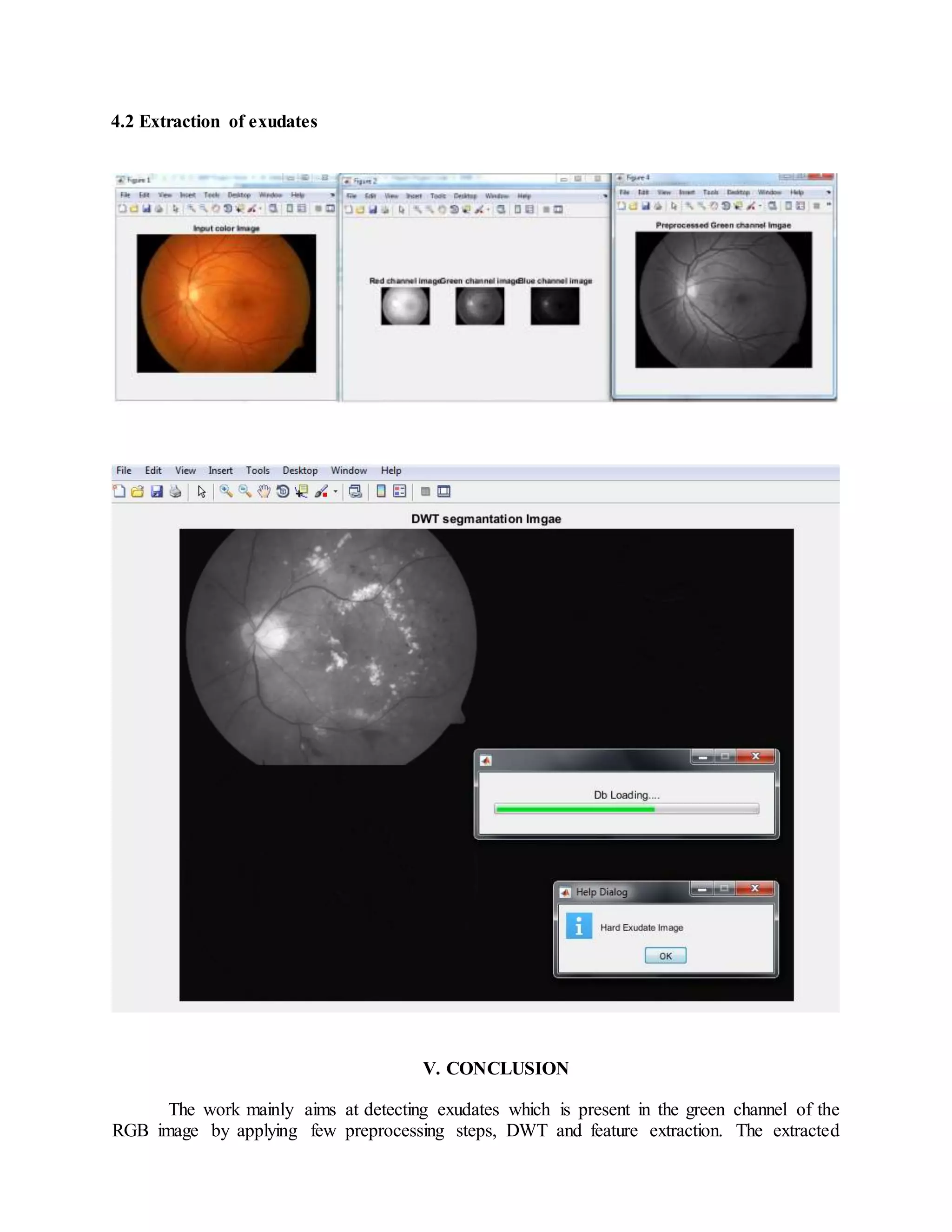4.2 Extraction of exudates
V. CONCLUSION
The work mainly aims at detecting exudates which is present in the green channel of the
RGB image by applying few preprocessing steps, DWT and feature extraction. The extracted
 