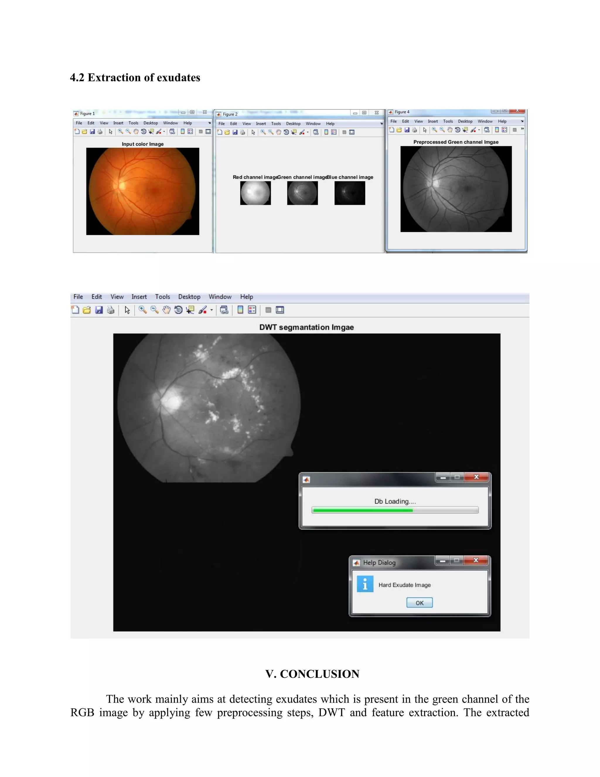 4.2 Extraction of exudates
V. CONCLUSION
The work mainly aims at detecting exudates which is present in the green channel of the
RGB image by applying few preprocessing steps, DWT and feature extraction. The extracted
 