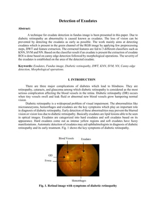 Detection of Exudates
Abstract:
A technique for exudate detection in fundus image is been presented in this paper. Due to
diabetic retinopathy an abnormality is caused known as exudates. The loss of vision can be
prevented by detecting the exudates as early as possible. The work mainly aims at detecting
exudates which is present in the green channel of the RGB image by applying few preprocessing
steps, DWT and feature extraction. The extracted features are fed to 3 different classifiers such as
KNN, SVM and NN. Based on the classifier result if an exudate is present the extraction of exudate
ROI is done based on canny edge detection followed by morphological operations. The severity of
the exudates is established on the area of the detected exudate.
Keywords: Exudates, Fundus image, Diabetic retinopathy, DWT, KNN, SVM, NN, Canny edge
detection, Morphological operations.
I. INTRODUCTION
There are three major complications of diabetes which lead to blindness. They are
retinopathy, cataracts, and glaucoma among which diabetic retinopathy is considered as the most
serious complication affecting the blood vessels in the retina. Diabetic retinopathy (DR) occurs
when tiny vessels swell and leak fluid or abnormal new blood vessels grow hampering normal
vision.
Diabetic retinopathy is a widespread problem of visual impairment. The abnormalities like
microaneurysms, hemorrhages and exudates are the key symptoms which play an important role
in diagnosis of diabetic retinopathy. Early detection of these abnormalities may prevent the blurred
vision or vision loss due to diabetic retinopathy. Basically exudates are lipid lesions able to be seen
in optical images. Exudates are categorized into hard exudates and soft exudates based on its
appearance. Hard exudates come out as intense yellow regions and soft exudates have fuzzy
manifestations. Automatic detection of exudates may aid ophthalmologists in diagnosis of diabetic
retinopathy and its early treatment. Fig. 1 shows the key symptoms of diabetic retinopathy.
Fig. 1. Retinal image with symptoms of diabetic retinopathy
 