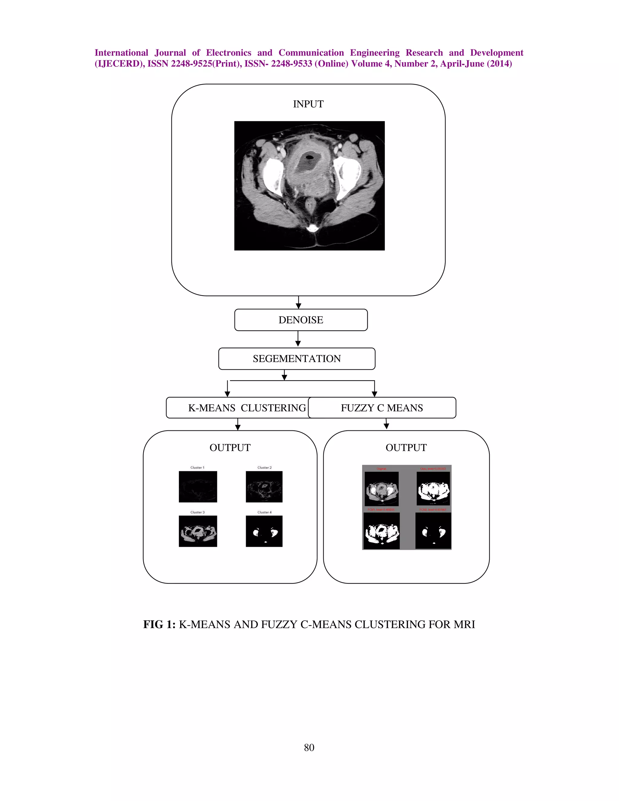 International Journal of Electronics and Communication Engineering Research and Development
(IJECERD), ISSN 2248-9525(Print), ISSN- 2248-9533 (Online) Volume 4, Number 2, April-June (2014)
80
FIG 1: K-MEANS AND FUZZY C-MEANS CLUSTERING FOR MRI
OUTPUT OUTPUT
INPUT
DENOISE
SEGEMENTATION
K-MEANS CLUSTERING FUZZY C MEANS
 