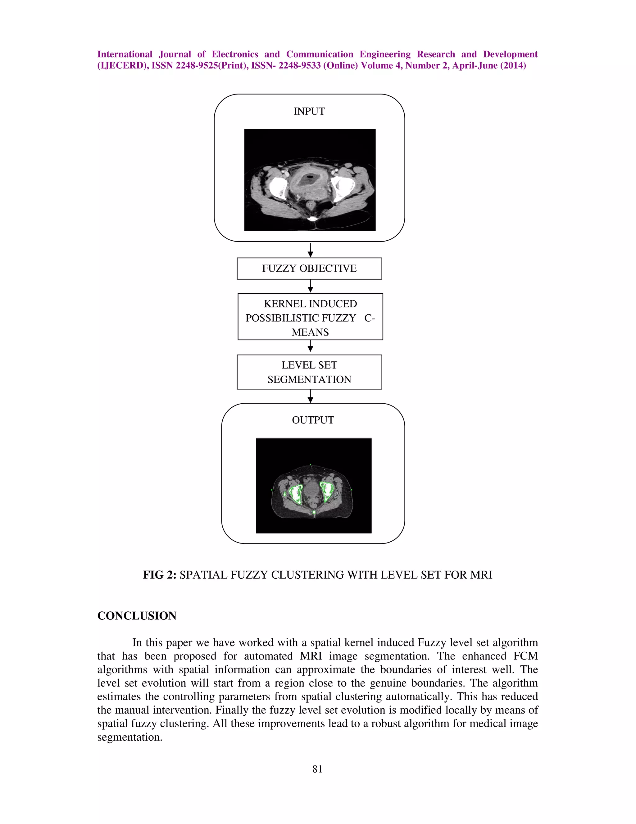 International Journal of Electronics and Communication Engineering Research and Development
(IJECERD), ISSN 2248-9525(Print), ISSN- 2248-9533 (Online) Volume 4, Number 2, April-June (2014)
81
FIG 2: SPATIAL FUZZY CLUSTERING WITH LEVEL SET FOR MRI
CONCLUSION
In this paper we have worked with a spatial kernel induced Fuzzy level set algorithm
that has been proposed for automated MRI image segmentation. The enhanced FCM
algorithms with spatial information can approximate the boundaries of interest well. The
level set evolution will start from a region close to the genuine boundaries. The algorithm
estimates the controlling parameters from spatial clustering automatically. This has reduced
the manual intervention. Finally the fuzzy level set evolution is modified locally by means of
spatial fuzzy clustering. All these improvements lead to a robust algorithm for medical image
segmentation.
INPUT
KERNEL INDUCED
POSSIBILISTIC FUZZY C-
MEANS
FUZZY OBJECTIVE
LEVEL SET
SEGMENTATION
OUTPUT
 
