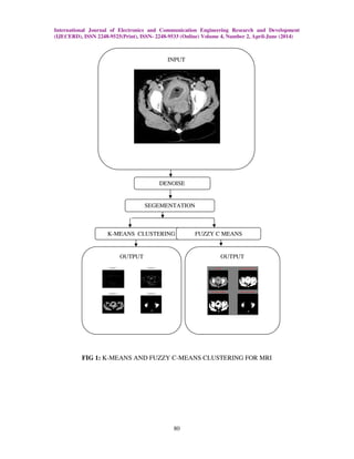 International Journal of Electronics and Communication Engineering Research and Development
(IJECERD), ISSN 2248-9525(Print), ISSN- 2248-9533 (Online) Volume 4, Number 2, April-June (2014)
80
FIG 1: K-MEANS AND FUZZY C-MEANS CLUSTERING FOR MRI
OUTPUT OUTPUT
INPUT
DENOISE
SEGEMENTATION
K-MEANS CLUSTERING FUZZY C MEANS
 