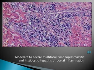 Moderate to severe multifocal lymphoplasmacytic and histiocytic hepatitis or portal inflammation