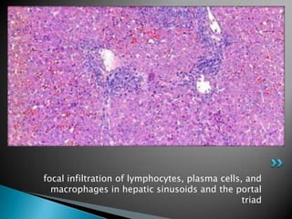 focal infiltration of lymphocytes, plasma cells, and macrophages in hepatic sinusoids and the portal triad 