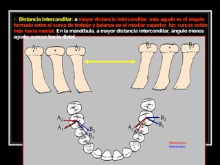 2.  Distancia intercondilar:  a  mayor distancia intercondilar, más agudo es el ángulo formado entre el surco de trabajo y balanza en el maxilar superior, los surcos están más hacia mesial . En la mandíbula, a mayor distancia intercondilar, ángulo menos agudo, surcos hacia distal.  Mediotrusion laterotrusion 