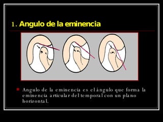 1. Angulo de la eminencia Angulo de la eminencia es el ángulo que forma la eminencia articular del temporal con un plano horizontal. 