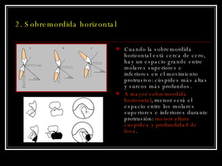 2. Sobremordida horizontal Cuando la sobremordida horizontal está cerca de cero, hay un espacio grande entre molares superiores e inferiores en el movimiento protrusivo: cúspides más altas y surcos más profundos. A mayor sobremordida horizontal , menor será el espacio entre los molares superiores e inferiores durante protrusión:  menor altura cuspídea y profundidad de fosa . 