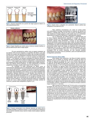 Determinantes del Dx Periodontal | PDF