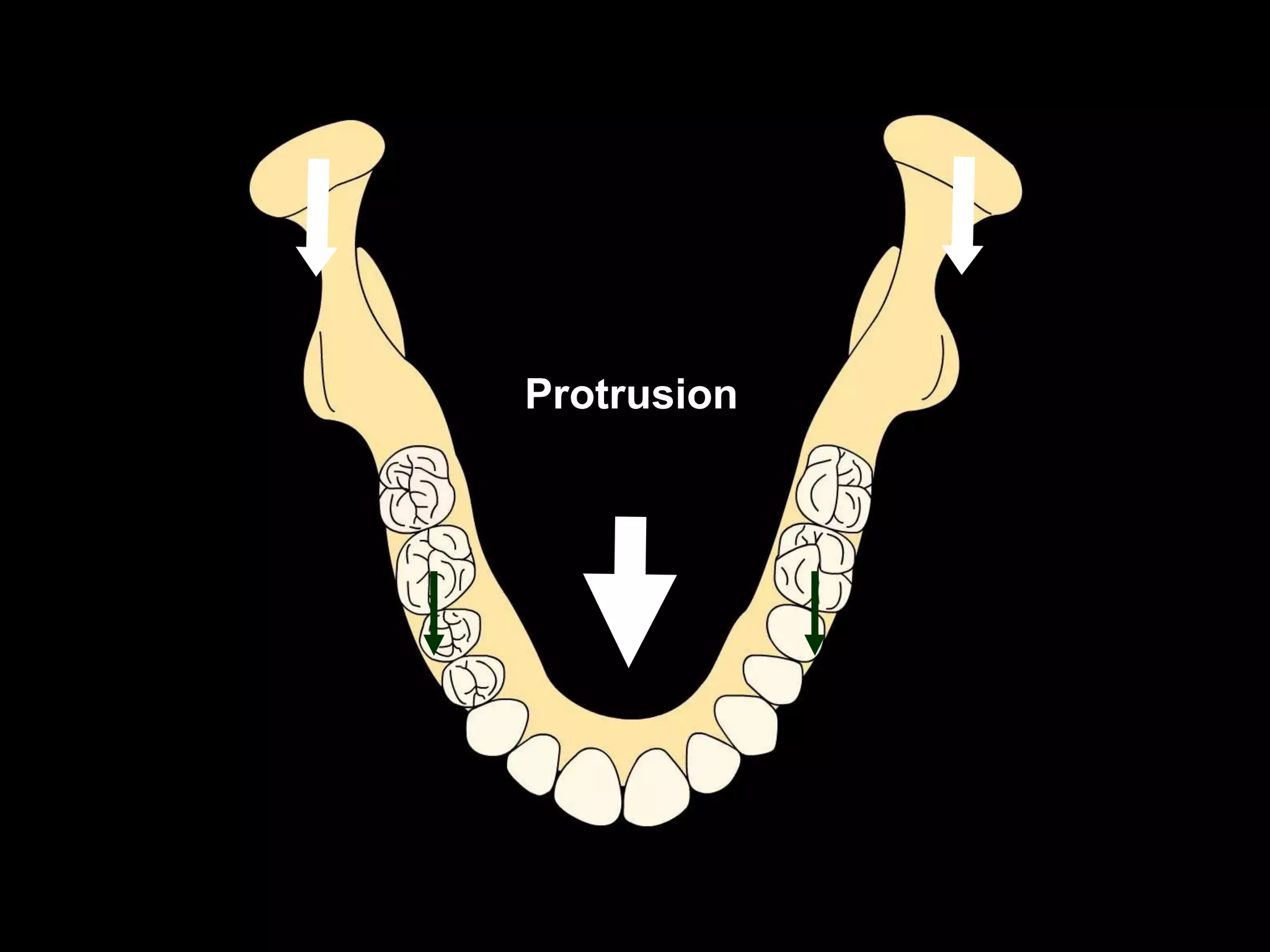 Protrusion
 