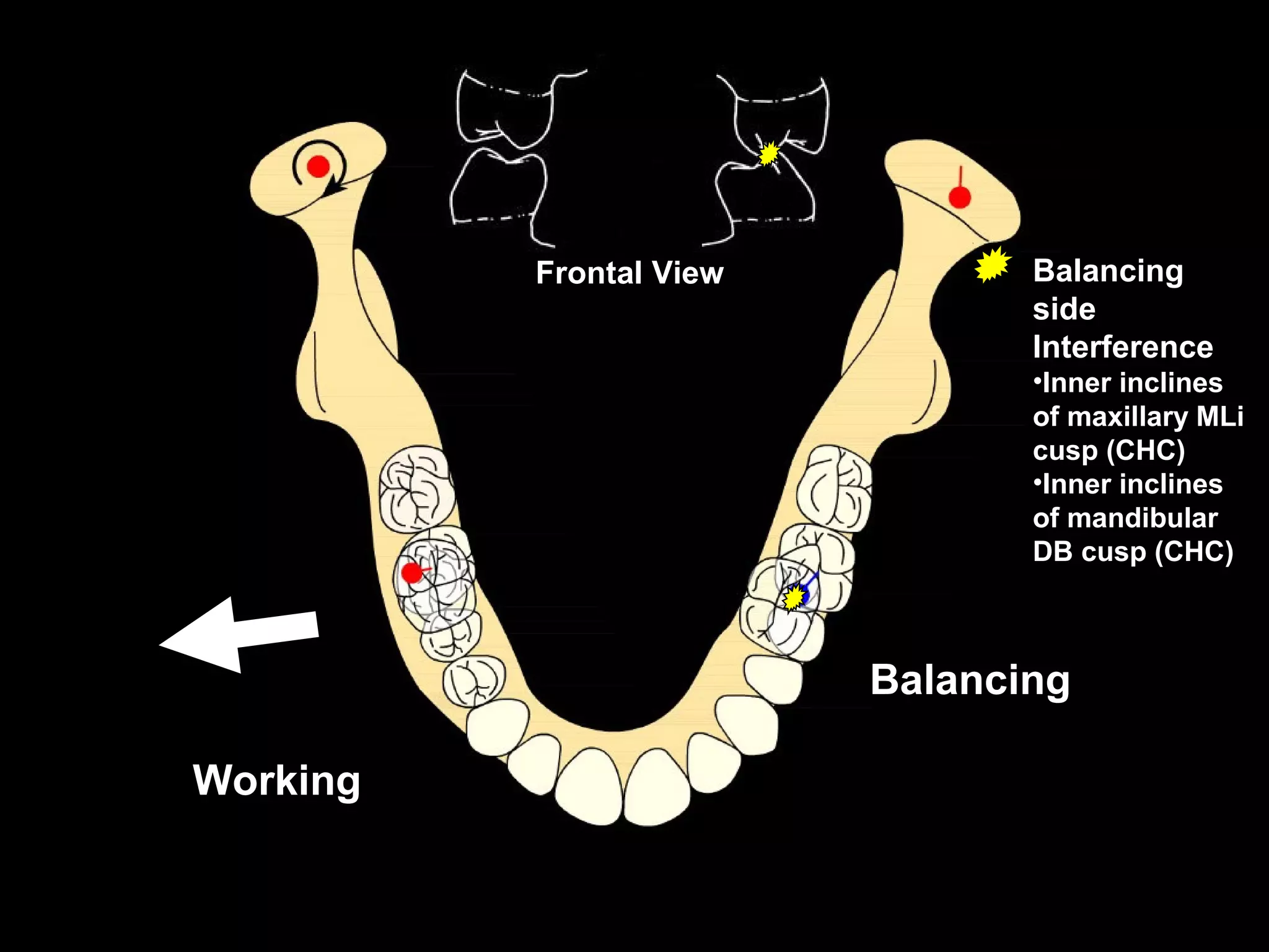 Frontal View          Balancing
                                side
                                Interference
                                •Inner inclines
                                of maxillary MLi
                                cusp (CHC)
                                •Inner inclines
                                of mandibular
                                DB cusp (CHC)



                         Balancing

Working
 