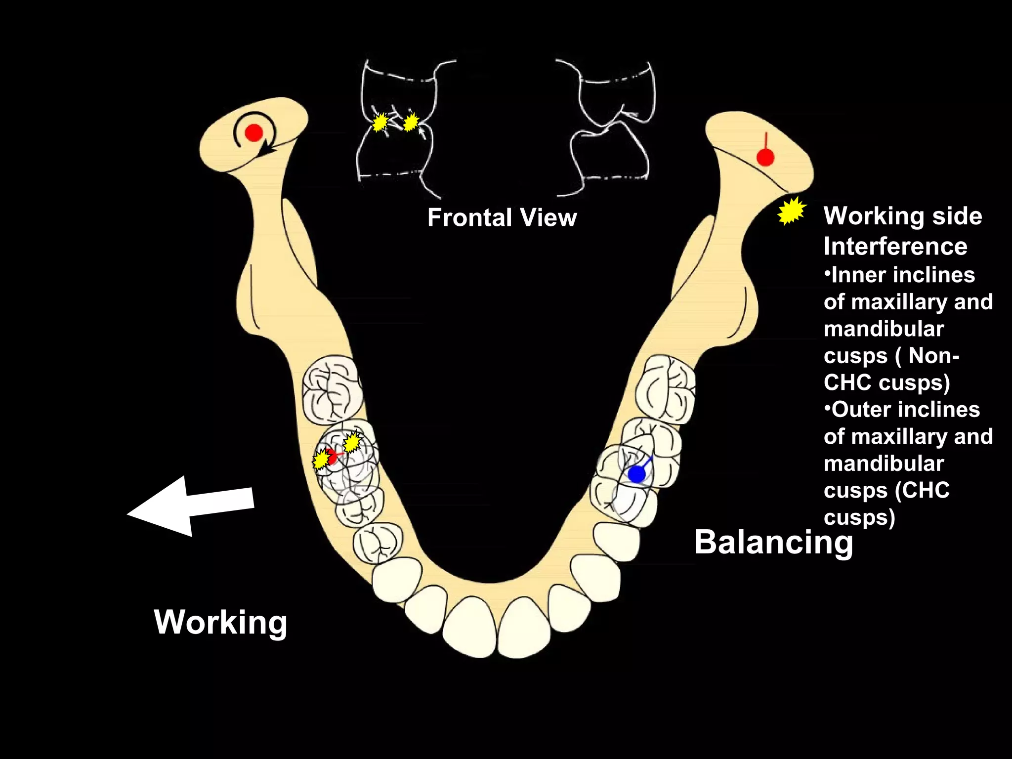 Frontal View          Working side
                                Interference
                                •Inner inclines
                                of maxillary and
                                mandibular
                                cusps ( Non-
                                CHC cusps)
                                •Outer inclines
                                of maxillary and
                                mandibular
                                cusps (CHC
                                cusps)
                         Balancing

Working
 