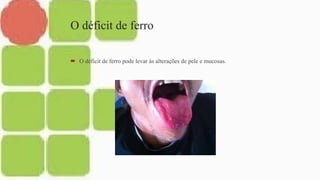 O déficit de ferro
 O déficit de ferro pode levar às alterações de pele e mucosas.
 
