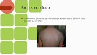 Excesso de ferro
 Geralmente, os indivíduos com excesso de ferro têm a pele cor cinza-
azulada ou metálica
 