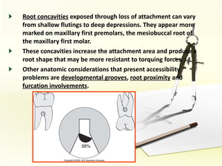 Root concavities  exposed through loss of attachment can vary from shallow flutings to deep depressions. They appear more marked on maxillary first premolars, the mesiobuccal root of the maxillary first molar. These concavities increase the attachment area and produce a root shape that may be more resistant to torquing forces. Other anatomic considerations that present accessibility problems are  developmental grooves ,  root proximity  and  furcation involvements .  