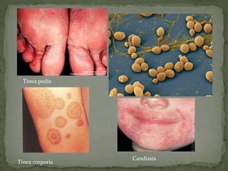 Tinea pedis
Candiasis
Tinea corporis