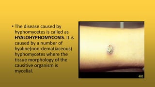 • The disease caused by
hyphomycetes is called as
HYALOHYPHOMYCOSIS. It is
caused by a number of
hyaline(non-dematiaceous)
hyphomycetes where the
tissue morphology of the
causitive organism is
mycelial.
 