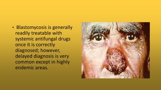 • Blastomycosis is generally
readily treatable with
systemic antifungal drugs
once it is correctly
diagnosed; however,
delayed diagnosis is very
common except in highly
endemic areas.
 