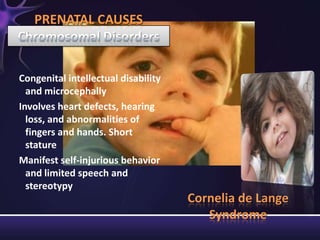 Congenital intellectual disability
and microcephally
Involves heart defects, hearing
loss, and abnormalities of
fingers and hands. Short
stature
Manifest self-injurious behavior
and limited speech and
stereotypy
PRENATAL CAUSES
Cornelia de Lange
Syndrome
 