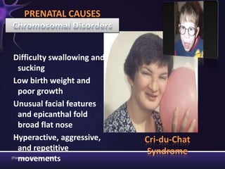 (Pierangelo & Giuliani,2007)
Difficulty swallowing and
sucking
Low birth weight and
poor growth
Unusual facial features
and epicanthal fold
broad flat nose
Hyperactive, aggressive,
and repetitive
movements
PRENATAL CAUSES
Cri-du-Chat
Syndrome
 