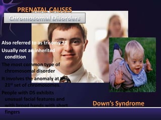 Also referred to as trisomy 21
Usually not an inherited
condition
The most common type of
chromosomal disorder
It involves the anomaly at the
21st set of chromosomes.
People with DS exhibits
unusual facial features and
with broad hands with short
fingers
PRENATAL CAUSES
Down’s Syndrome
 
