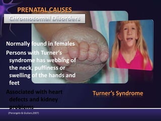 Turner’s Syndrome
Normally found in females
Persons with Turner’s
syndrome has webbing of
the neck, puffiness or
swelling of the hands and
feet
Associated with heart
defects and kidney
problems
PRENATAL CAUSES
(Pierangelo & Giuliani,2007)
 