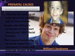 William’s Syndrome
Caused by the absence of
material on the seventh
pair of chromosome.
People with William’s
syndrome exhibit heart
defects and “elfin” facial
features.
Their unusual sensitivity
to sound makes them
competent in music and
language despite of their
low IQ level.
PRENATAL CAUSES
 