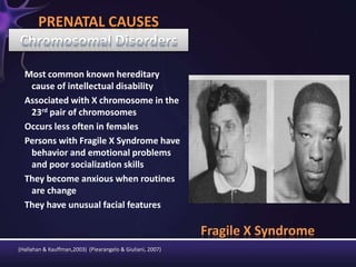 Fragile X Syndrome
Most common known hereditary
cause of intellectual disability
Associated with X chromosome in the
23rd pair of chromosomes
Occurs less often in females
Persons with Fragile X Syndrome have
behavior and emotional problems
and poor socialization skills
They become anxious when routines
are change
They have unusual facial features
PRENATAL CAUSES
(Hallahan & Kauffman,2003) (Piearangelo & Giuliani, 2007)
 